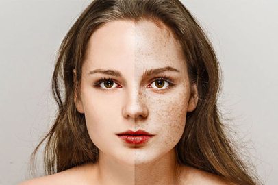 برداشتن کک و مک | کلینیک زیبایی غرب
