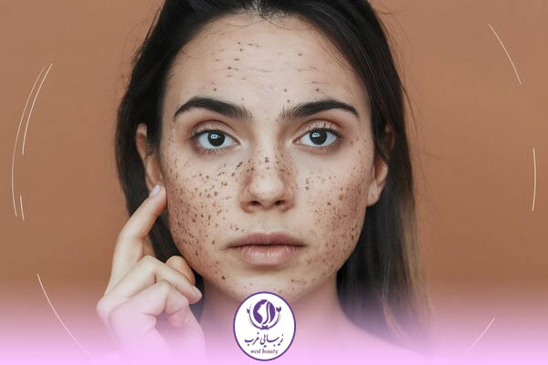 سریعترین راه از بین بردن لکه قهوه ای صورت در خانه