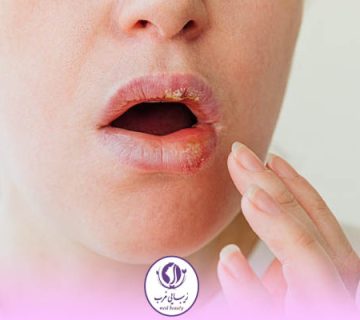 نکروز لب بعد از تزریق ژل