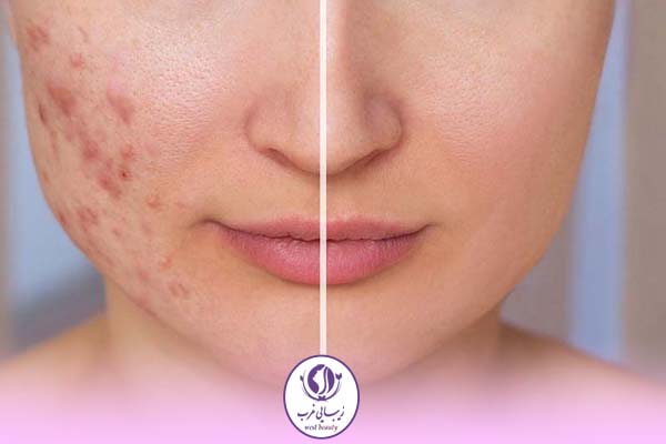 مهمترین نکات در مراقبت های بعد از سابسیژن 