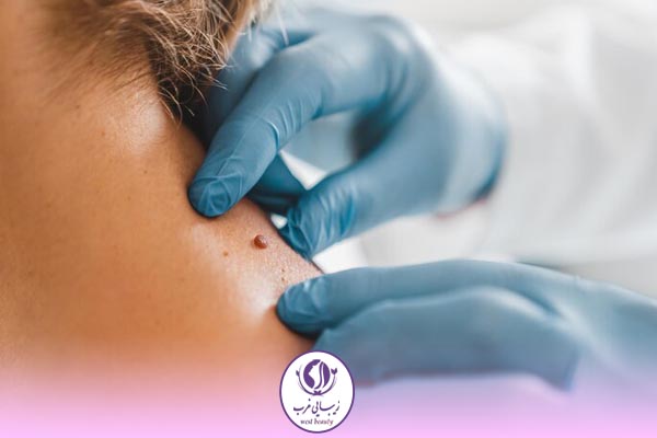 مزایای برداشتن خال با لیزر