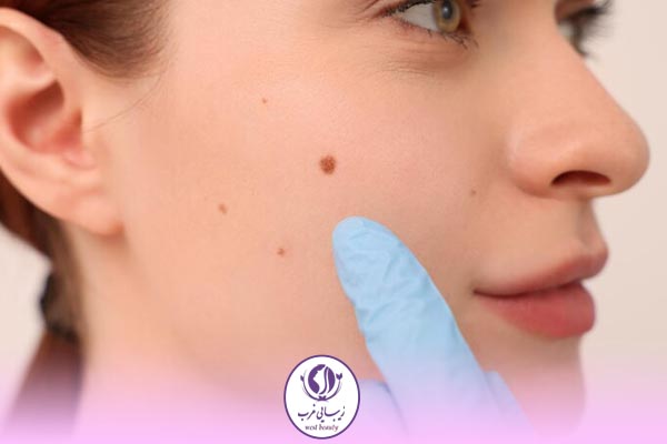عوارض برداشتن خال صورت با لیزر 