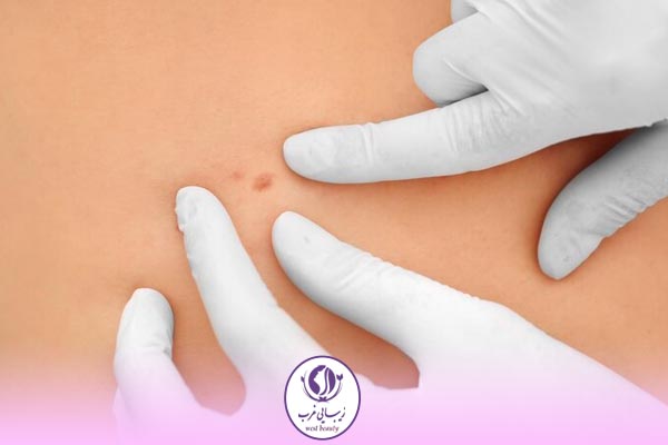 روش های برداشتن خال چیست؟