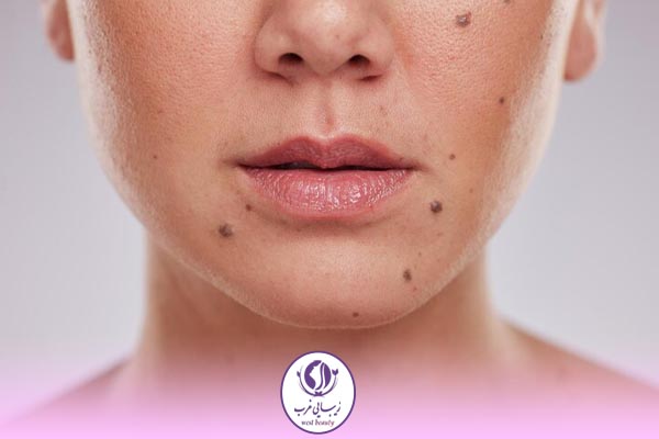عوارض برداشتن خال صورت