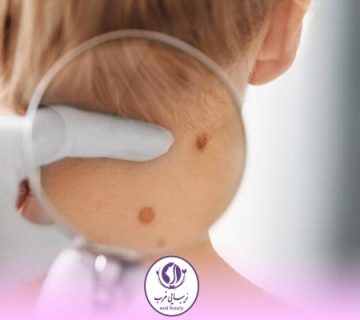 برداشتن خال با لیزر