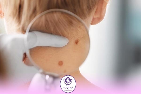 برداشتن خال با لیزر