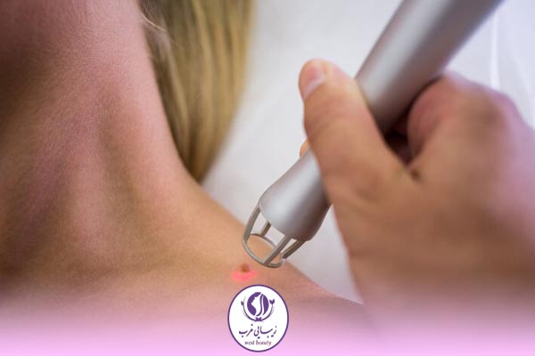 نحوه استفاده از پماد بعد ریموو خال