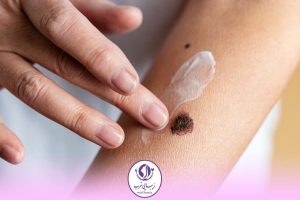 معرفی بهترین پماد بعد از برداشتن خال