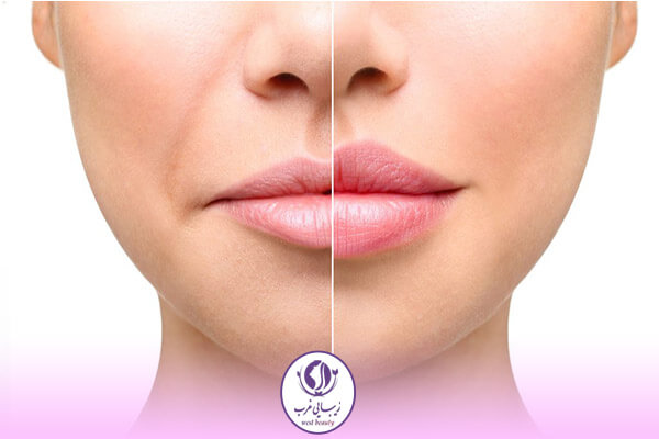 ژل لب مدل غنچه‌ای