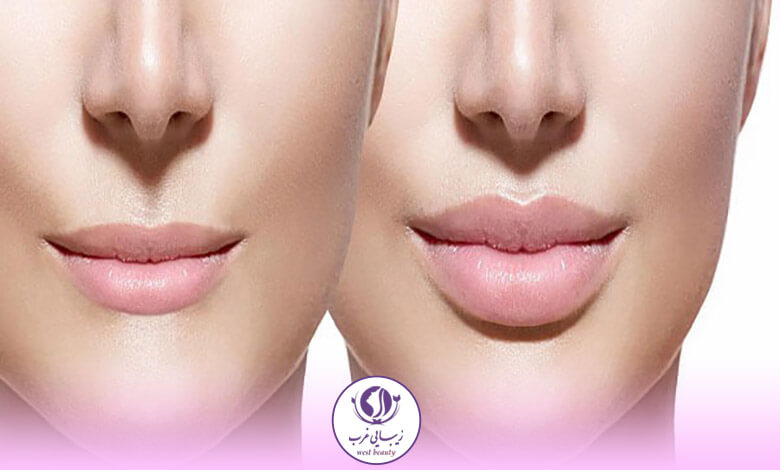 تزریق چربی به لب