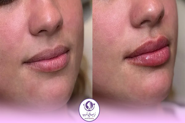 فیلر لب مدل نچرال