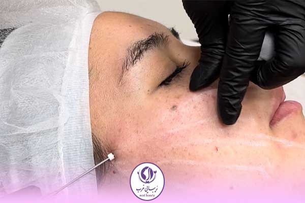 لیفت با نخ برای چه نواحی مناسب است