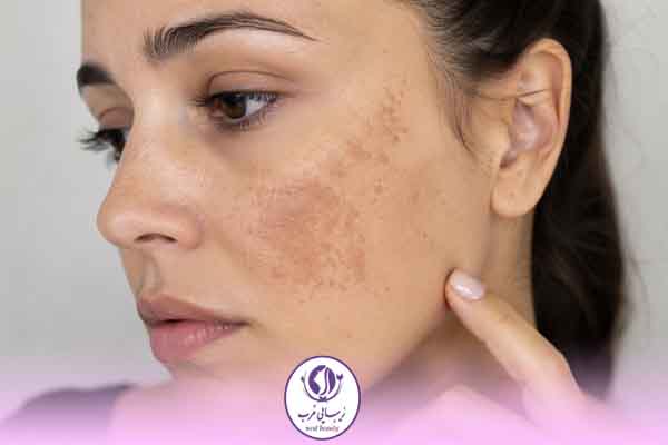 کدام لکه های پوستی خطرناکند؟