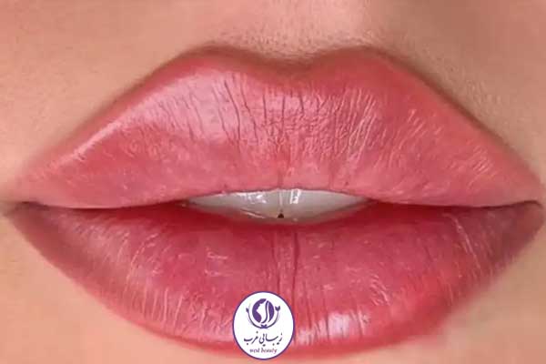 تزریق ژل لب عروسکی در غرب تهران