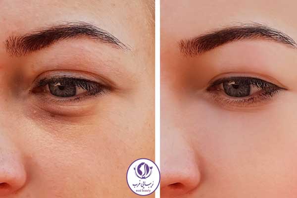 عوارض تزریق فیلر زیر چشم چیست
