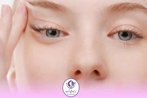 بوتاکس چشم گربه ای چیست