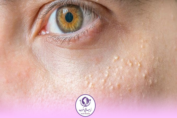میلیا چیست؟