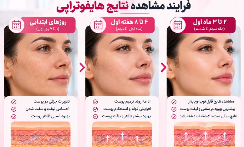نتیجه هایفوتراپی بعد از چند روز مشخص میشود؟